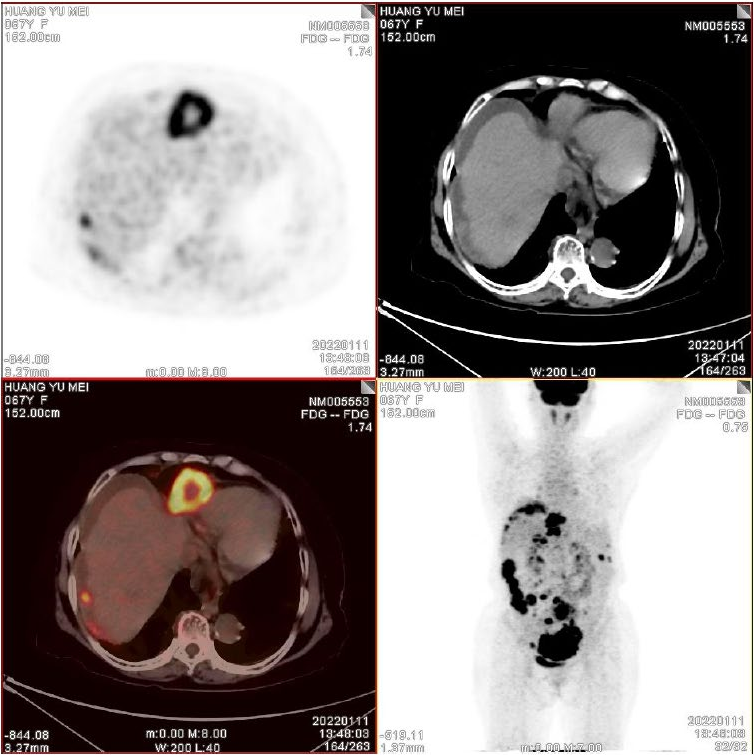 術(shù)前PET-CT (1).png